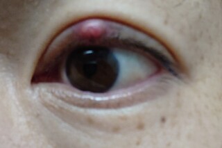 自分で潰す 霰粒腫