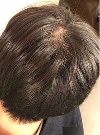 高校生です 男 このつむじはやばいですか 禿げるのが怖いデス Yahoo 知恵袋