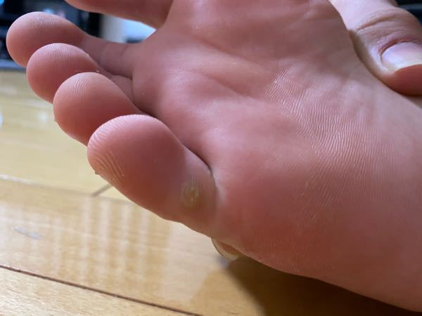 足の裏にタコのようなモノが出来たんですけど これってタコですか それとも魚の目 Yahoo 知恵袋