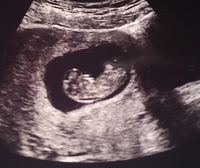 妊娠9週5日の妊婦です 今日検診でエコーを見たら胎児の首の後ろに浮腫 Yahoo 知恵袋