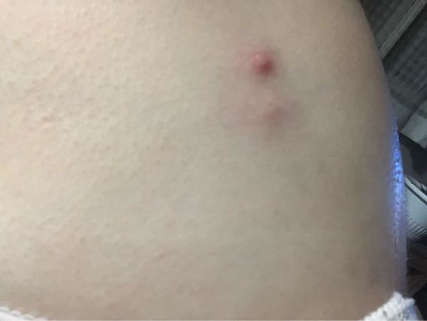 背中 粉瘤 に関するq A Yahoo 知恵袋