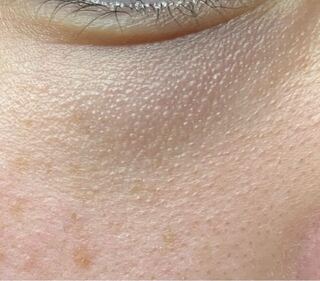 目の下が 毛穴というより凸のようになっています またそこがクマのように黒く見え Yahoo 知恵袋