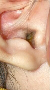 これ中耳炎の膿に見えますか 耳垢に見えますか 3ヶ月の赤ちゃん Yahoo 知恵袋