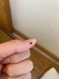 最近ほくろのような物が指に出来ました 危険な物でしょうか Yahoo 知恵袋