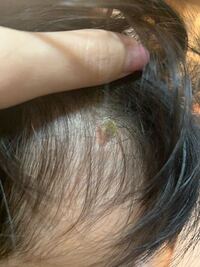 さっき気がついたのですが９ヶ月の子供の頭皮に茶色いシミみたいな Yahoo 知恵袋