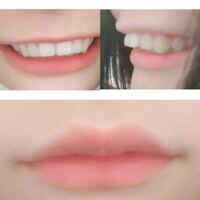 私は人より少し歯が出ています 口は普通に閉じれるのですが 笑うと出てます男 Yahoo 知恵袋