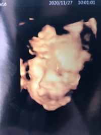 現在27w1dの妊婦です 今日産婦人科でエコーを撮ったところ気になることがあっ Yahoo 知恵袋