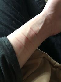 病んでないのにリスカしてしまいます わたしが辛くてリスカしていたのは2 Yahoo 知恵袋