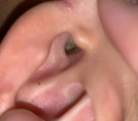 閲覧注意 耳垢の写真あり 子供の耳垢はどの程度で耳鼻科に行って撮ってもらいます Yahoo 知恵袋