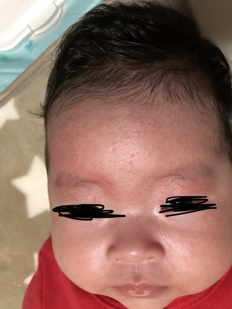 もう少しで生後2ヶ月になる子ですが 最近になってオデコ 瞼 首に湿疹がでてきま Yahoo 知恵袋