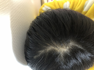 中学生女子です最近抜け毛などが酷く頭皮が見えてる感じですハゲですか Yahoo 知恵袋