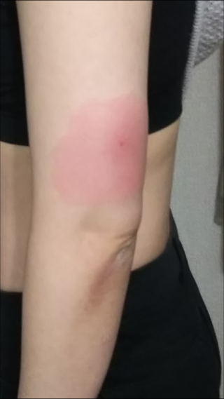 インフル予防接種あと これは腫れやすい類 痛痒そうですね 私は Yahoo 知恵袋