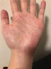 何年か前から 手に赤い斑点の様なものがでて 痒みが酷いです 写真のも Yahoo 知恵袋