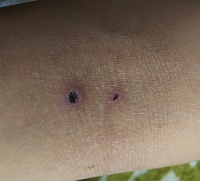 １ ２週間前から 右腕の肘裏に黒いかさぶたのようなものが出来ました 見覚 Yahoo 知恵袋