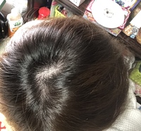 わたしハゲてますか 最近頭皮が痛く 写真を撮ったらこんな感じでした Yahoo 知恵袋