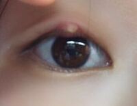 ものもらいについて質問です 一昨日 上瞼が腫れてしまい眼科に行ってものもらいの Yahoo 知恵袋