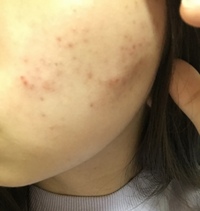 ニキビ跡 についてです何回か頬のニキビを繰り返し今にはニキビというの Yahoo 知恵袋