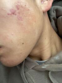 このニキビ跡 シミ はメラノccなどでも消えますかね オススメ Yahoo 知恵袋