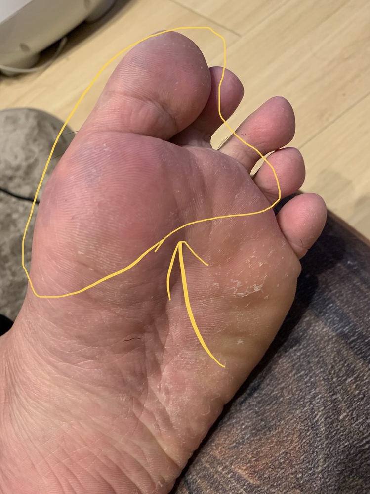 足の鬱血 皮膚の色が一部 赤紫色のまだらになっています 年齢は30歳 Yahoo 知恵袋