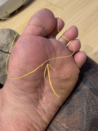 足の鬱血 皮膚の色が一部 赤紫色のまだらになっています 年齢は30歳 Yahoo 知恵袋