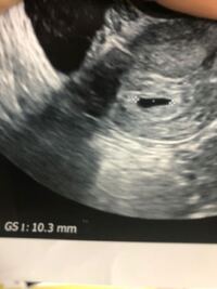 妊娠初期の出血について質問です 今回体外受精で陽性反応をもらい喜んでいた Yahoo 知恵袋