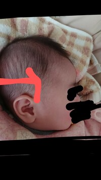 ４ヶ月の娘です 三角頭蓋 頭蓋骨縫合早期癒合症についてです 画像あり Yahoo 知恵袋