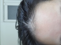 女子高生です 最近 前髪の薄毛が気になります センター分けや 普通に下ろ Yahoo 知恵袋