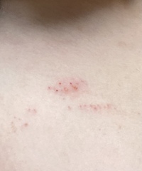 デコルテにぷつぷつぷつとダニ 虫刺され のようなものが数カ所できます 写真のよ Yahoo 知恵袋