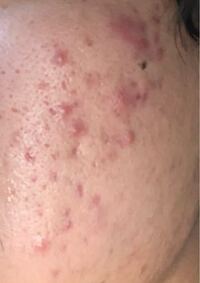 このようなニキビは治るまでどのくらいの期間がかかるでしょうか Yahoo 知恵袋