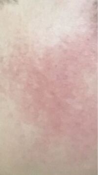 生まれつき頬が赤いんですけどどうやったら治りますかね シカペアクリー Yahoo 知恵袋