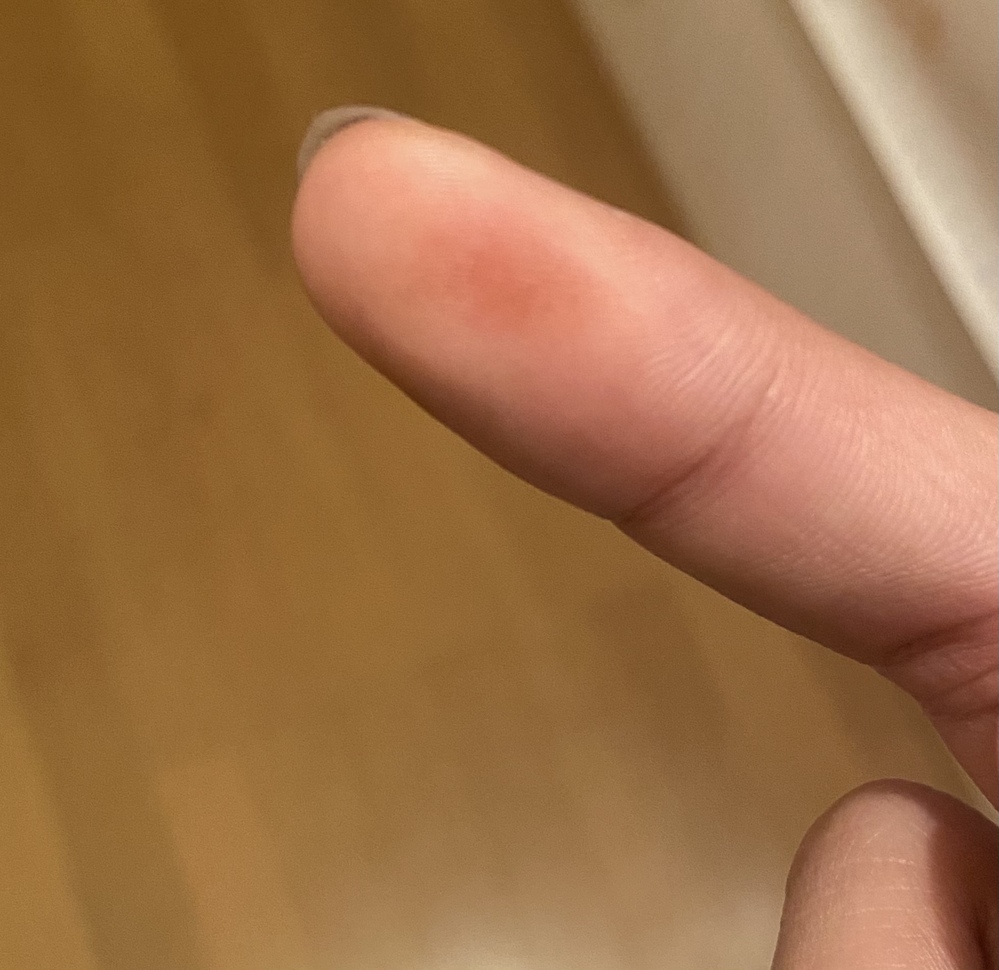 Ee 病名 軟膏 メドロール ネオ
