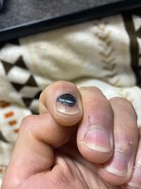 病院に行った方が良いでしょうか 手の爪なのですが 少し前にぶつけて内出血 Yahoo 知恵袋