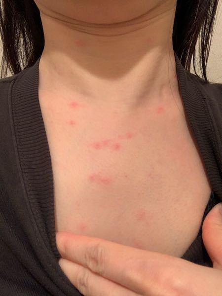 皮膚の病気 アトピー 解決済みの質問 Yahoo 知恵袋