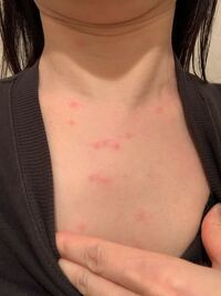 今朝起きたら写真のような赤い発疹ができていました 首元だけでなく腕や Yahoo 知恵袋