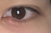 一昨日から目頭 涙袋 が腫れてます少し痒みもでてきました 9月頃にものもら Yahoo 知恵袋