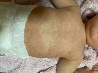 これって突発性発疹ですか 11ヶ月の赤ちゃん川崎病に１回かかってます 定 Yahoo 知恵袋