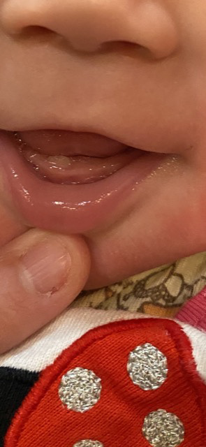 6ヶ月の赤ちゃんが口のあたりをぶつけてしまい 歯茎から出血しました 血は Yahoo 知恵袋