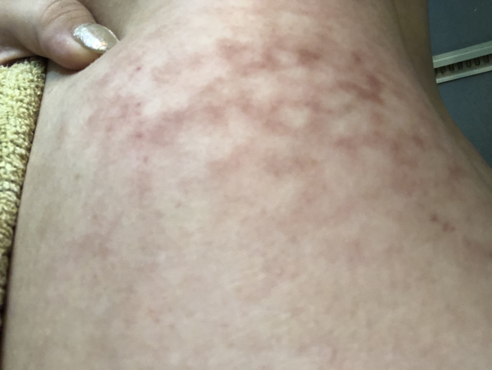 昨日ぐらいから 腰の辺りに赤い網目模様の疾患が出ていました 調べてみてもよくわ Yahoo 知恵袋