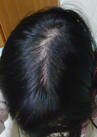 これってはげてますよね 24歳です また 頭皮に赤い湿疹のよう Yahoo 知恵袋