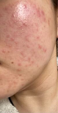 朝起きたらニキビ大量発生してました ニキビに効く物なんでもいい Yahoo 知恵袋