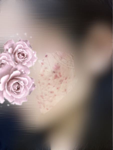 牛乳石鹸 アトピー に関するq A Yahoo 知恵袋