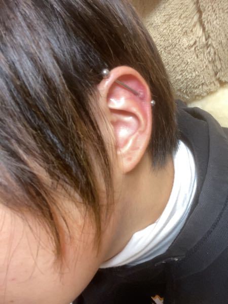 皮膚の病気 アトピー 解決済みの質問 Yahoo 知恵袋