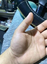 左手の親指の付け根が腫れて青くなってるのですが何かわかりますか Yahoo 知恵袋