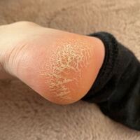 汚い写真申し訳ないです 保湿クリーム塗っててもかかとの Yahoo 知恵袋