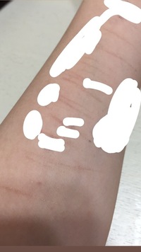 リスカ跡についてです。私はアイドルをしていて、来週撮影会というイベントがあります。 跡はそんなにすごくないのですがファンの方が私を指名してくれて撮影をしに来る大事なイベントになっててそんな中堂々とリスカの跡をばらす訳にもいかないその写真をSNSに投稿する方もいると思うしリスカしてることを身内にもバレたくないので何とかして隠したいです。なにか隠す方法はないでしょうか。手首の落書きで身バレする可...