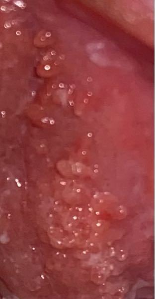 閲覧注意です ここ何日か陰部が痒く見てみたら 陰部の内側 の所にこのようなぶつ Yahoo 知恵袋