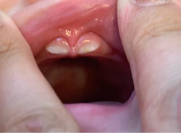 8ヶ月の娘の事です 娘の歯で2つ気になることがあります 1つはエナメル質 Yahoo 知恵袋