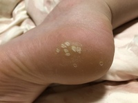 足の裏 かかとにポツポツポツと皮が硬くなってるところがあるのですがこれはなんで Yahoo 知恵袋