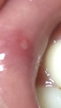 口内炎 口唇ヘルペスについて 1 28に恋人に口内炎ができていました 1 30 Yahoo 知恵袋