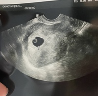 こんばんは 今日ちょうど7週になる妊婦です このエコーに血の塊は見え Yahoo 知恵袋